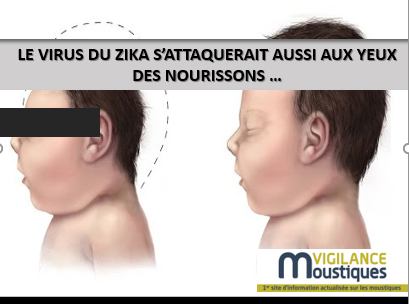 Article pour zika yeux